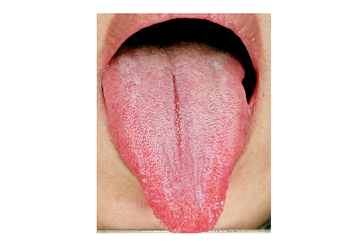 How To Determine Whether Liver Qi Stagnation By Tongue Diagnosis?