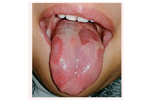 What Does the Tongue Symptom of Yin Deficiency?