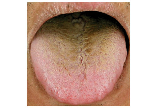 black tongue coating
