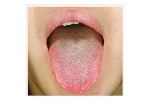 normal tongue