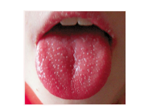 tongue body red
